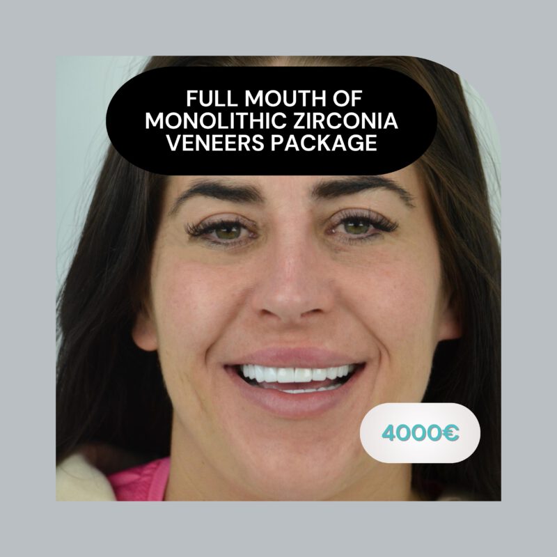 Full Mouth of Monolithic Zirconia Veneers Package Smile in Turkey